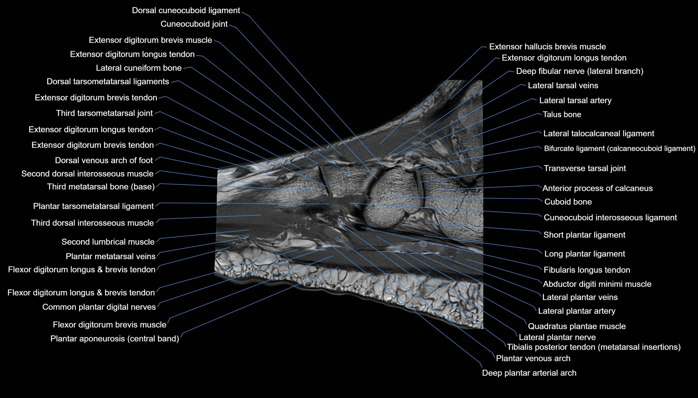 MRI mid foot sagittal cross sectional anatomy 3T  radiology  image-img-00001-00017.webp